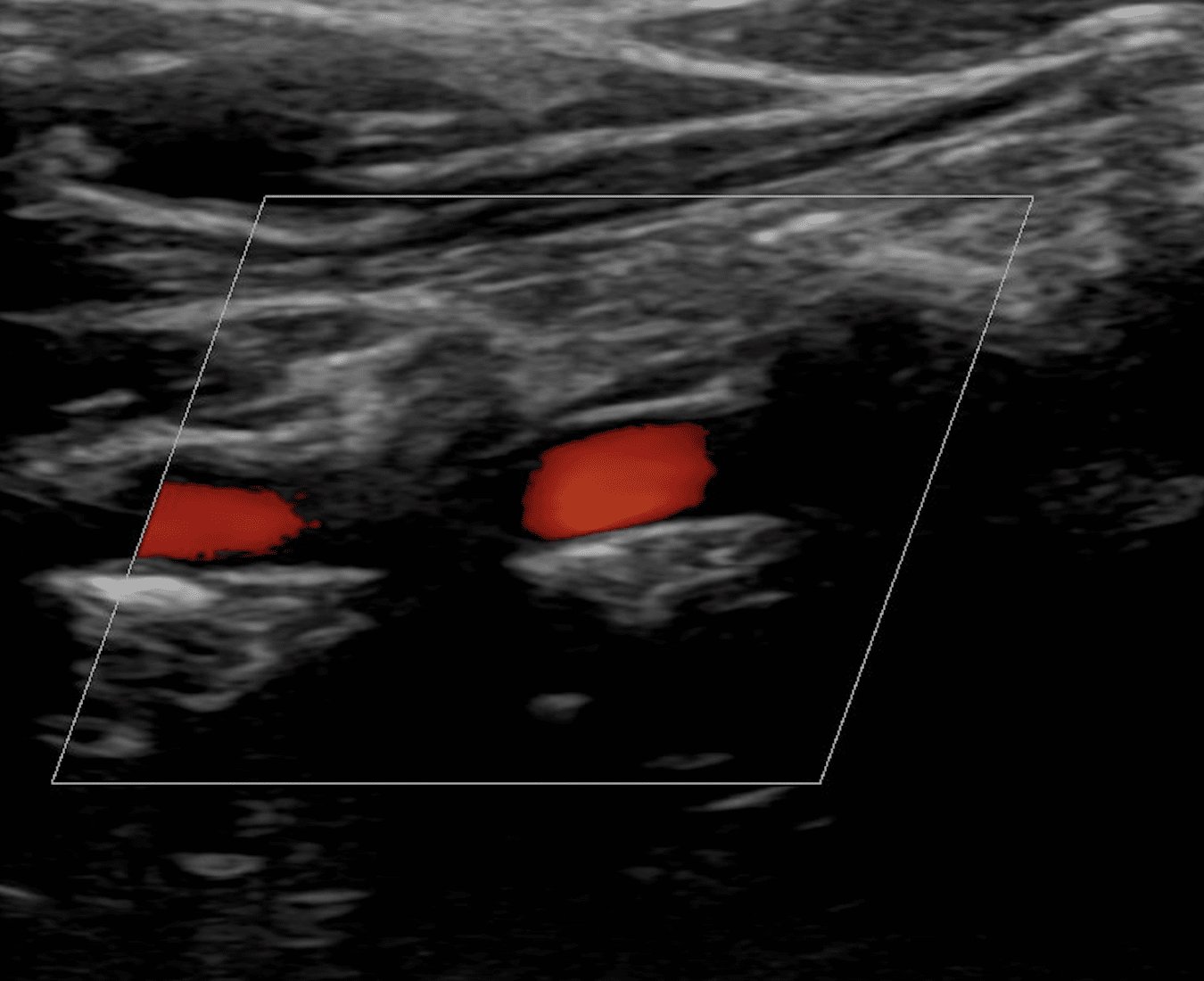 Ultraschal der Halsschlagader